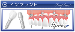 インプラント